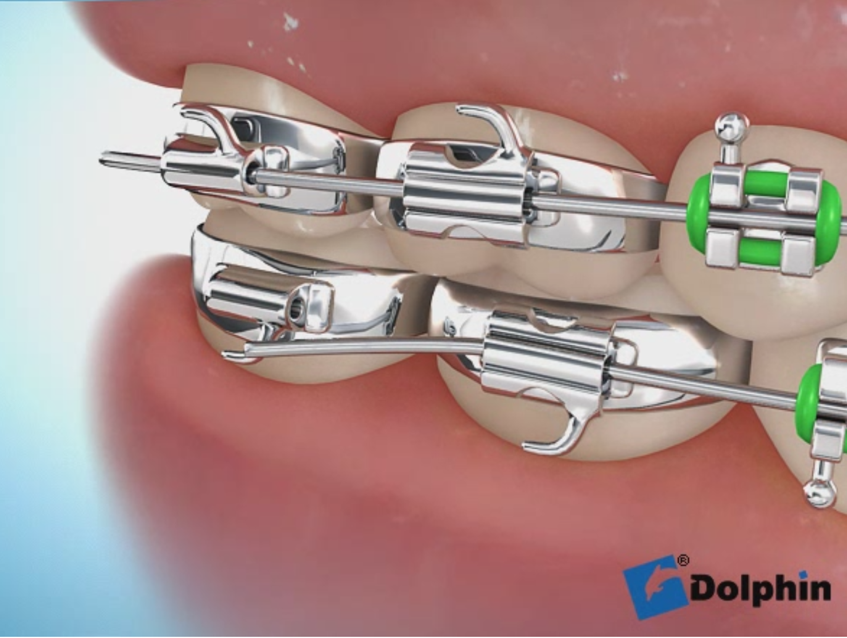 ワイヤーが伸びた状態