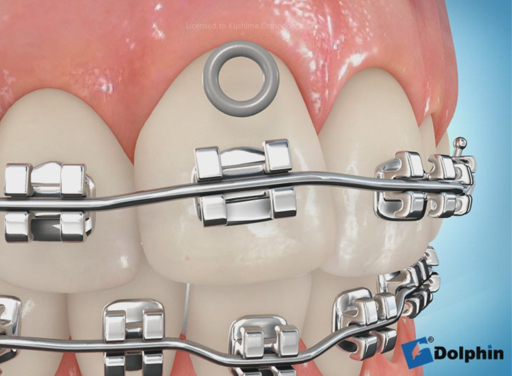 モジュール脱離