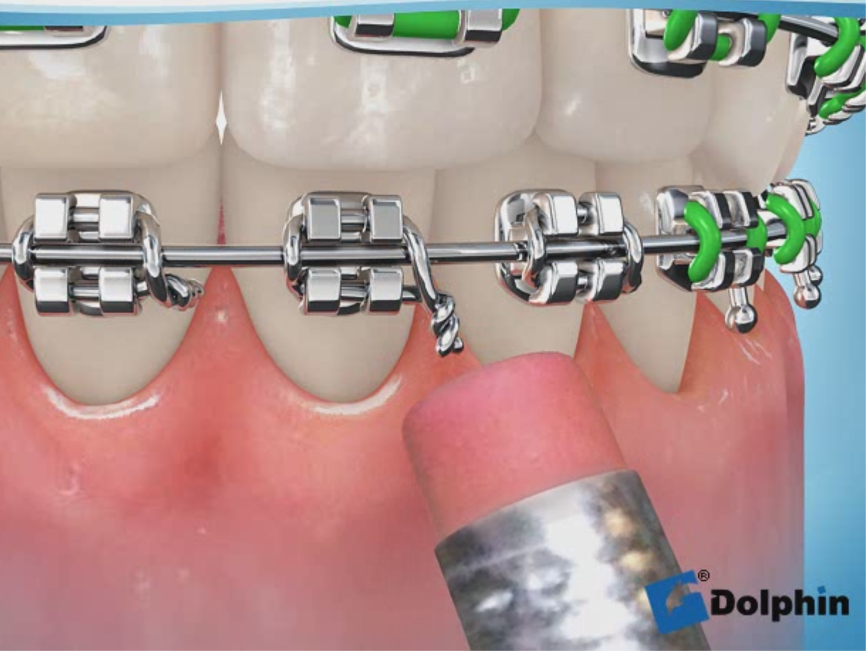 リガチャーワイヤーの飛び出し