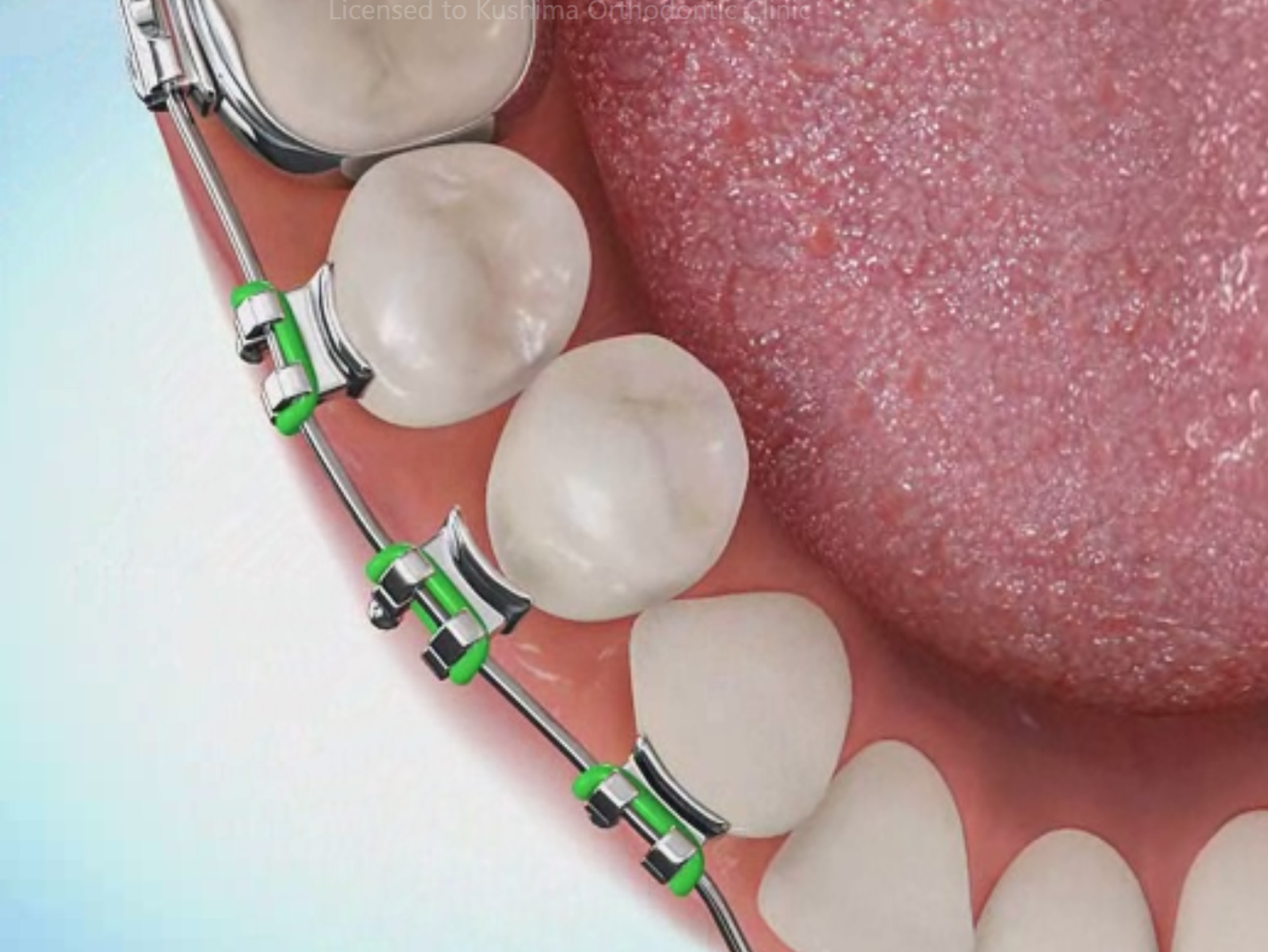 ブラケット脱離