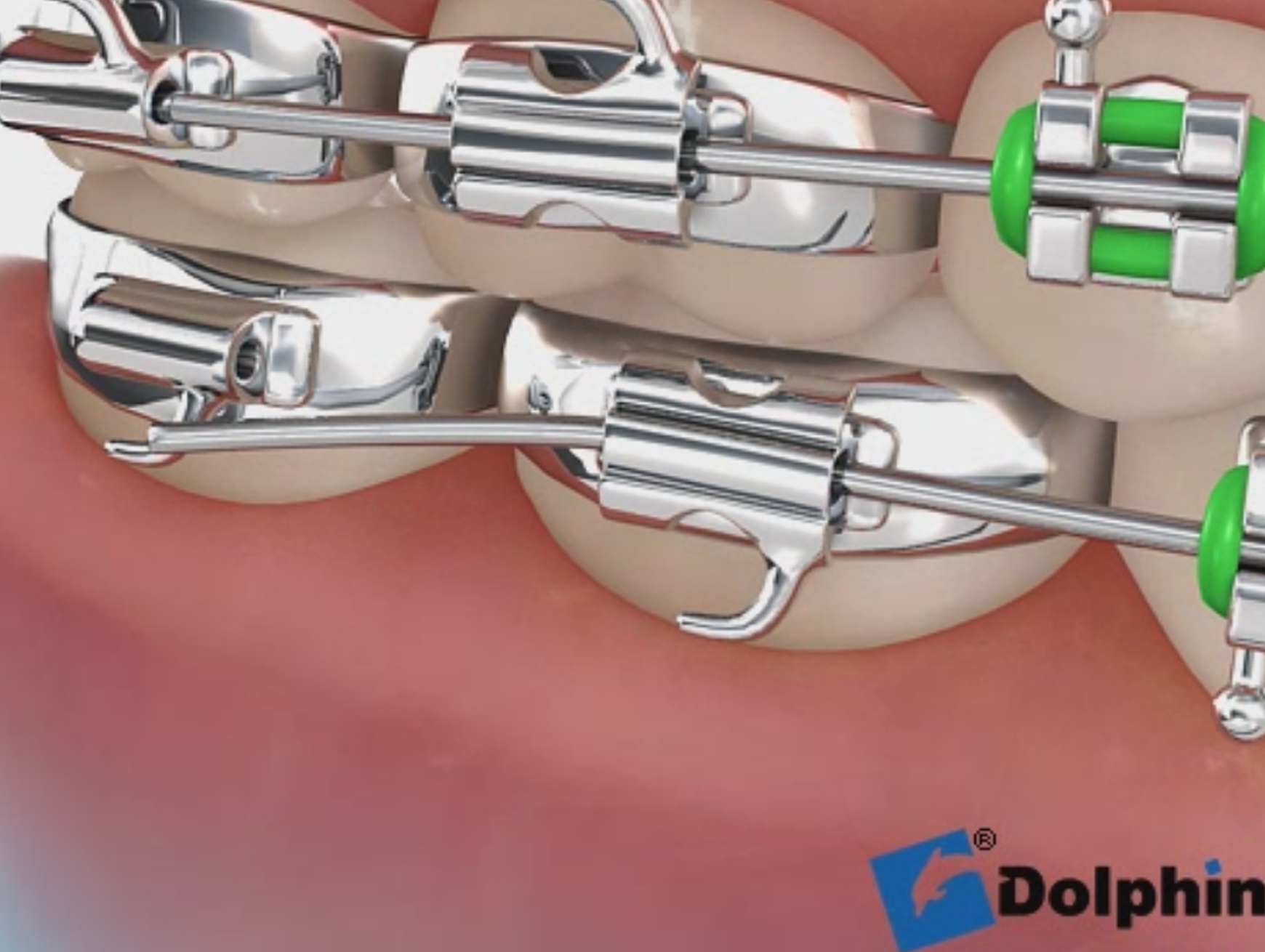 ワイヤーが抜けた