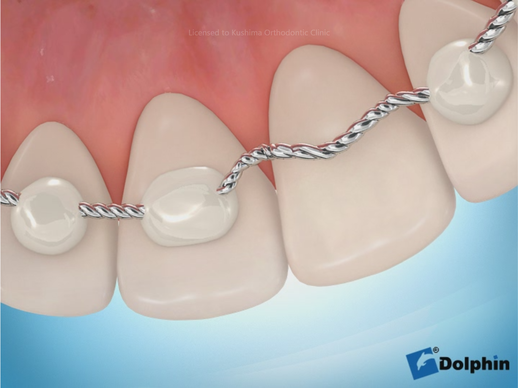 ボンディドリテーナー脱離